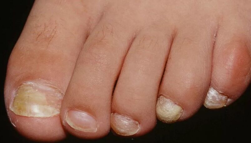Iltze onddoa thumb