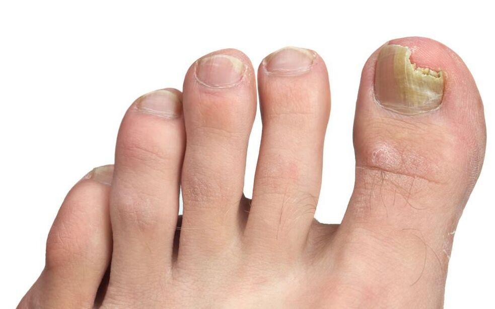 Onychomycosis