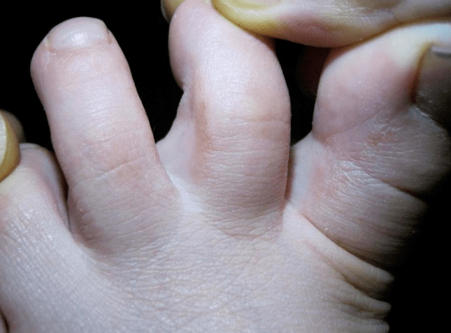 Mycosis haurrengan