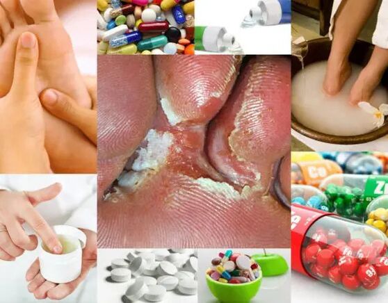 Mikosi interdigitala eta tratamendu metodoak