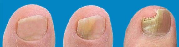 Onddoen garapen prozesua