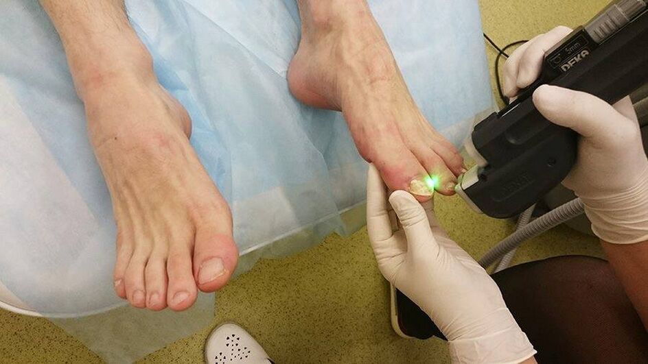 iltze onddoetarako laser terapia