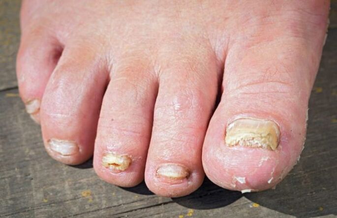 Rubromycosis onddoa oinetan